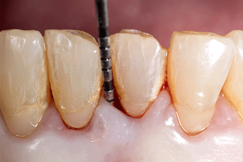 periodoncia-clinica-blanco-carrion