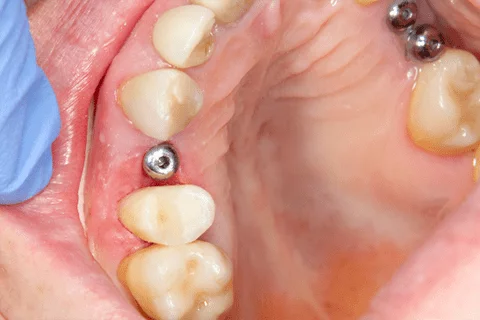 implantologia-clinica-blanco-carrion